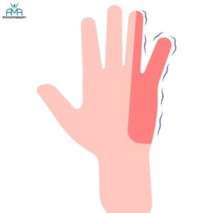 tingling in the hand with the cubital syndrome